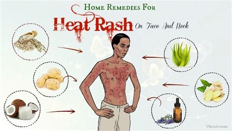 Heat Rash On Buttocks Treatment