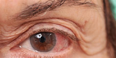 What Is Glaucoma? Symptoms, Causes And Treatment For The Eye Condition ...