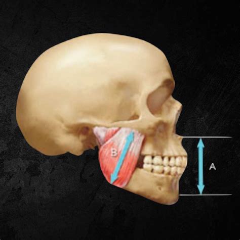 Altering the Vertical Dimension by Dr. John C. Cranham - Dentaltown