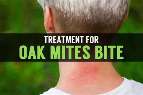 Oak Mites Treatment and Signs of Mite Bites