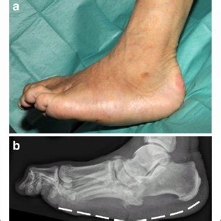 A typical Charcot foot in acute active phase: red, hot, and swollen ...