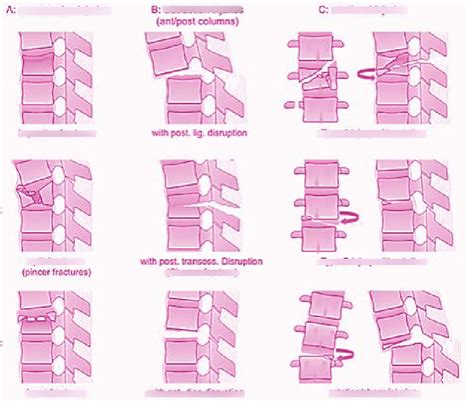 Spinal Fracture Types Diagram | Quizlet