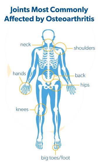 Osteoarthritis Symptoms and Diagnosis | Arthritis Society Canada