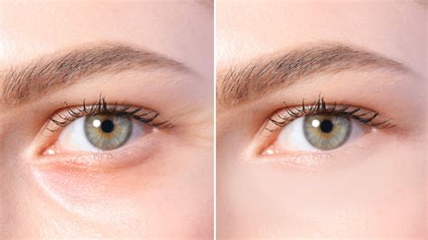 How To Get Rid Of Under Eye Wrinkles: Free Treatment Tips | PERFECT