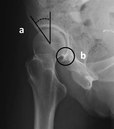 Examination of acetabular labral tear: a continued diagnostic challenge ...