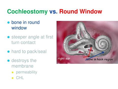 PPT - Round Window/Cochleostomy PowerPoint Presentation - ID:2449648