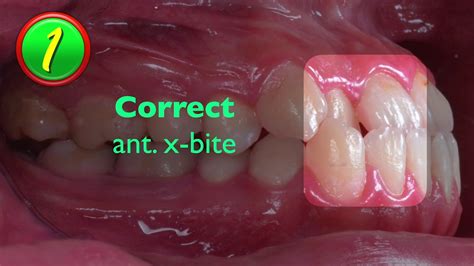 Correcting Anterior Crossbite for Patients with Extraction Space｜【Chris ...