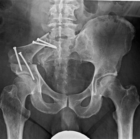 Life-Saving Pelvic Resection for Chondrosarcoma