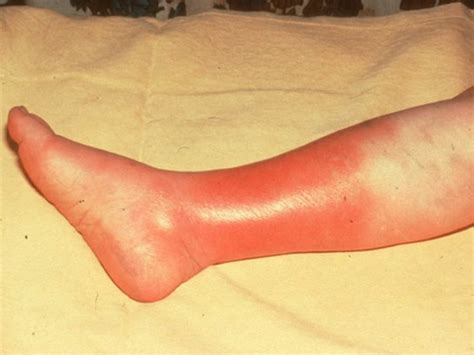 Cellulitis - Pictures, Symptoms, Treatment, Contagious, Causes, Types ...