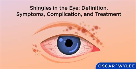 Shingles in the Eye: Symptoms, Complications, and More