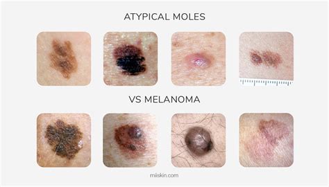 Cancerous Moles Vs Normal Moles