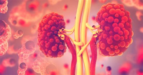 Polycystic Kidney Disease: Symptoms, Types, Causes, Diagnosis ...