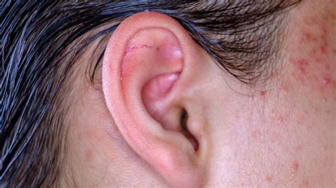 How To Pop A Pimple Deep In Your Ear at Paul Makris blog