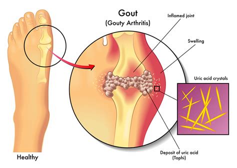 Gout in Foot? Here's How It Happens—and How to Treat It - University ...