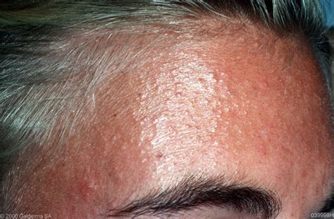 scalp folliculitis pictures - pictures, photos