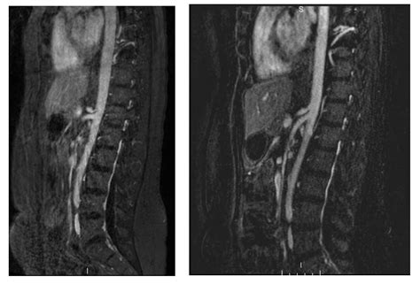 Median Arcuate Ligament Syndrome: Diagnosis and Treatment