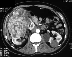 Oncocytoma - Kidney Case Studies - CTisus CT Scanning