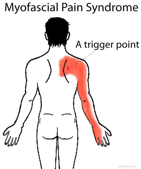 Back Pain: Upper, Middle, Right, Left, Sudden, Severe, Chronic ...