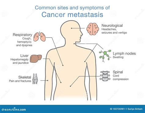 Most Common Sites And Symptoms Of Cancer Metastasis. Stock Vector ...