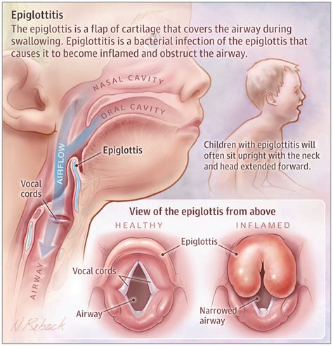 Epiglottitis | Medical knowledge, Medical anatomy, Medical education