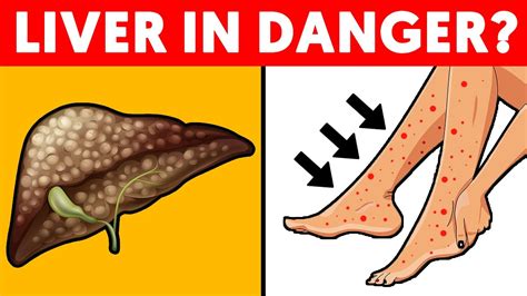 5 Signs of Liver Problems Hidden in Your Feet - YouTube