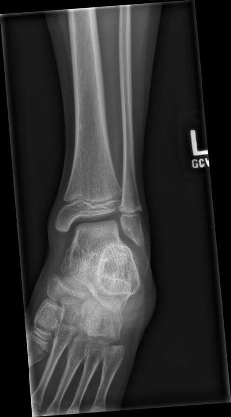 OrthoDx: Ankle Sprain or Salter-Harris Injury? - Clinical Advisor