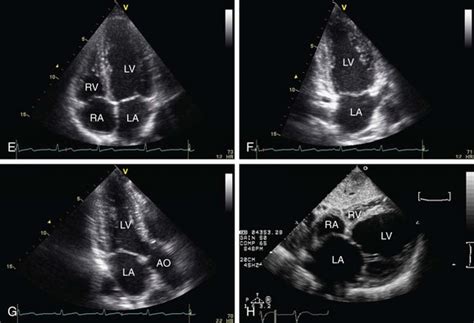 Echocardiography | Radiology Key