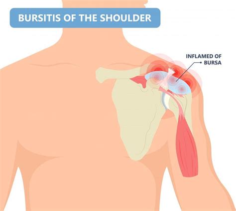 Shoulder Bursitis: Symptoms, Causes, Treatment, & More!: Elite Sports ...