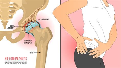 Hip Osteoarthritis: Treatment