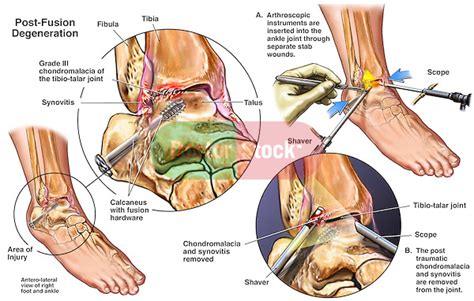 Additional Deterioration of the Ankle with Arthroscopic Debridement ...