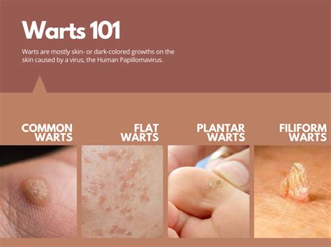 Warts: Signs & Symptoms - Dermatology Physicians Group Chicago Illinois