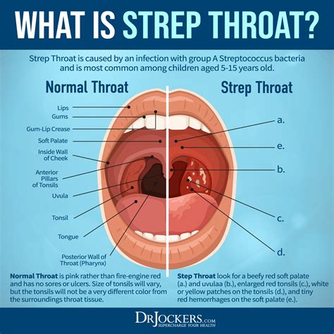 Strep Throat: Symptoms and 15 Natural Support Strategies