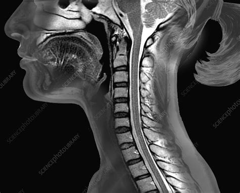 Cervical spine and brainstem, MRI scan - Stock Image C037/1654 ...