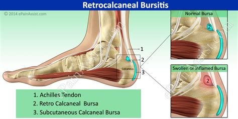 Retrocalcaneal Bursitis|Causes|Symptoms|Treatment|Exercise|Recovery