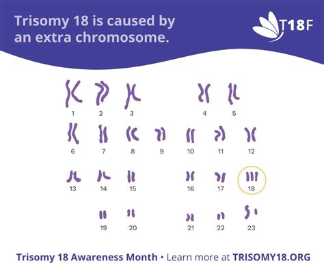 Trisomy18Foundation on Twitter: "Trisomy 18 may be caused by an extra ...