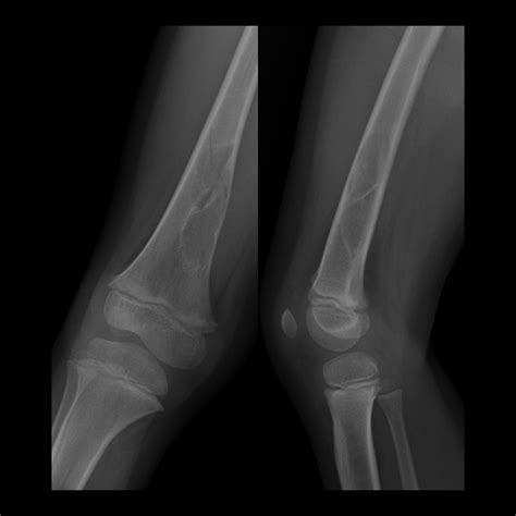 Fibrous Cortical Defect | Pediatric Radiology Reference Article ...