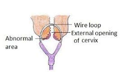 Loop Electrosurgical Excision Procedure in India | Healing Touristry ...