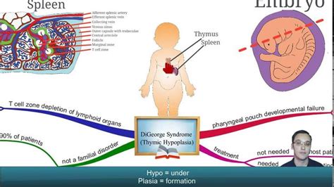 Digeorge syndrome