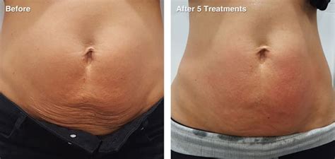 Fat Cavitation Results - The Global Beauty Group