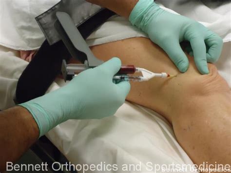 Tampa Stem Cell Knee Cartilage Repair - Sarasota, St. Petersburg, Venice