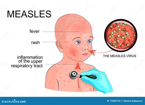 The Boy with the Symptoms of Rubella or Measles Stock Vector ...