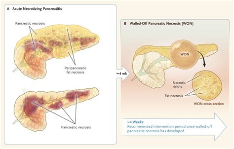 Drainage for Infected Pancreatic Necrosis — Is the Waiting the Hardest ...