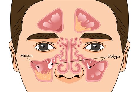 When is a biologic indicated for chronic rhinosinusitis with nasal ...