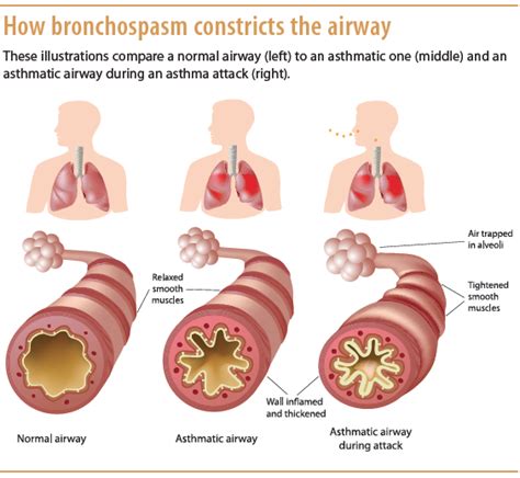 Understanding asthma pathophysiology, diagnosis, and management