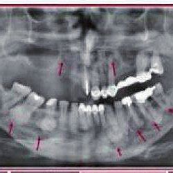 Periapical radiograph of cementoblastoma associated with the left ...