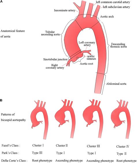 Frontiers | Aortic Dilatation in Patients With Bicuspid Aortic Valve