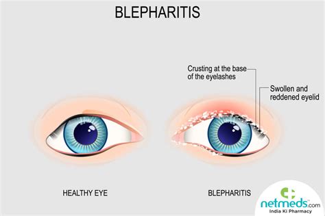 Blepharitis: Causes, Symptoms And Treatment | Netmeds