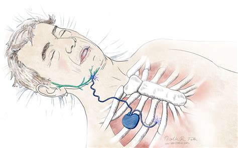 Chest Implant for Sleep Apnea - Portfolio - SayoStudio