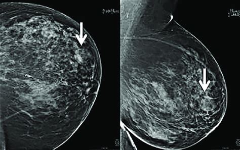 A 66-year-old female with abnormal screening mammogram showing a mixed ...