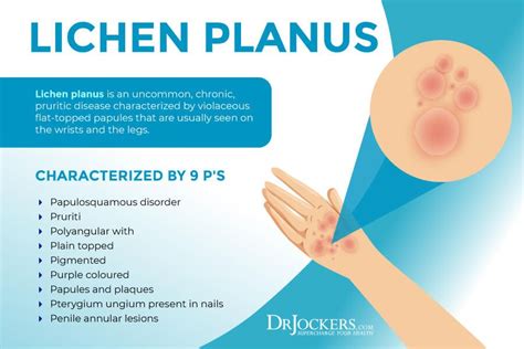 Lichen Planus: Symptoms, Causes & Support Strategies | Lichen planus ...